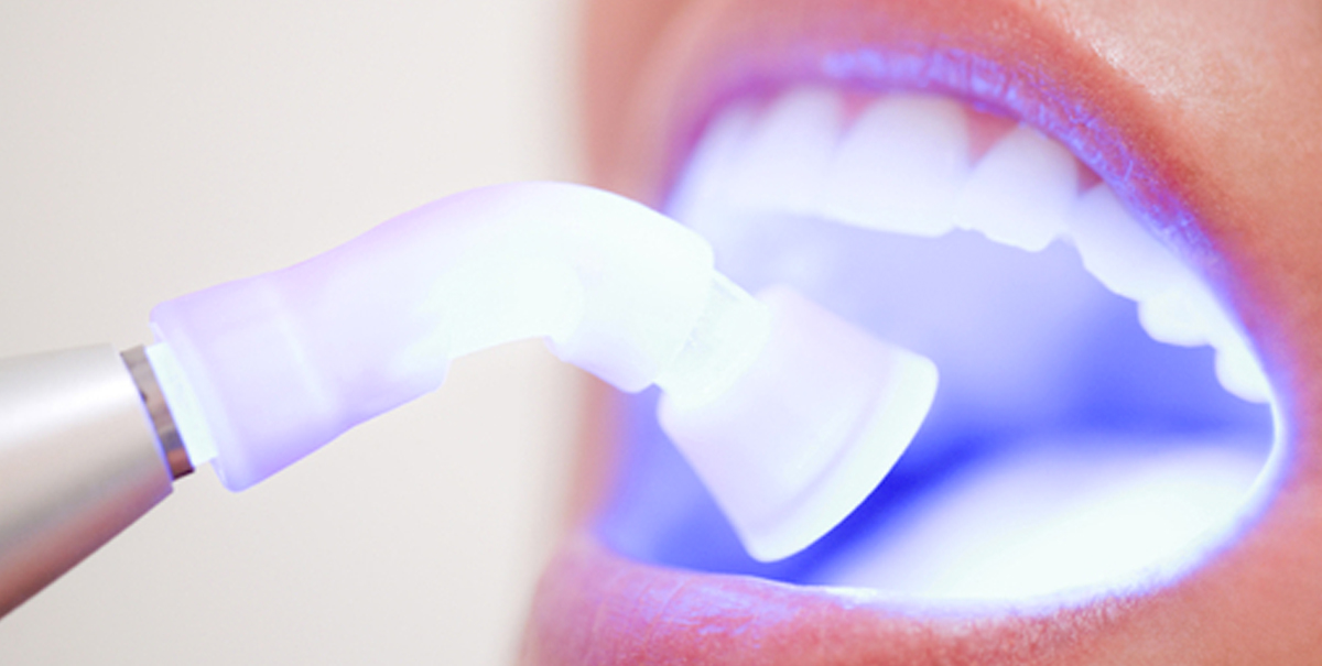duvidas sobre clareamento dental