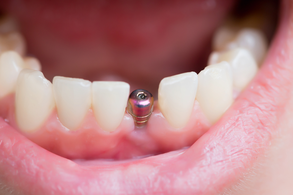 implante-dentario-clinica-prime-odonto-rj