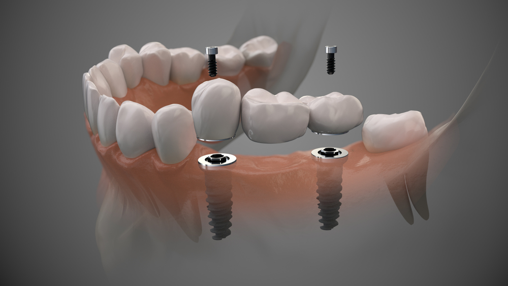 implante-dentario-clinica-prime-odonto